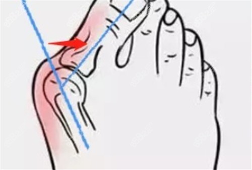 成都東籬醫(yī)院做大腳骨多少錢
