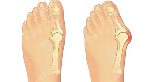 成都東籬醫(yī)院做微創(chuàng)拇外翻手術(shù)好不好