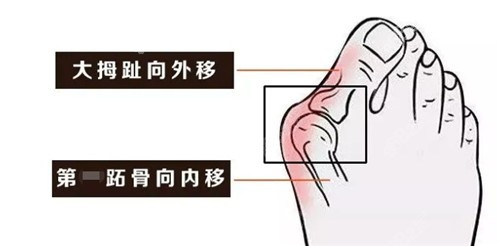 成都東籬醫(yī)院做微創(chuàng)拇外翻好不好