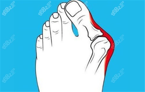 成都東籬醫(yī)院治療拇外翻手術(shù)口碑好