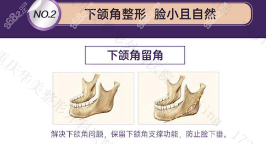 何才伟下颌角截骨怎么样