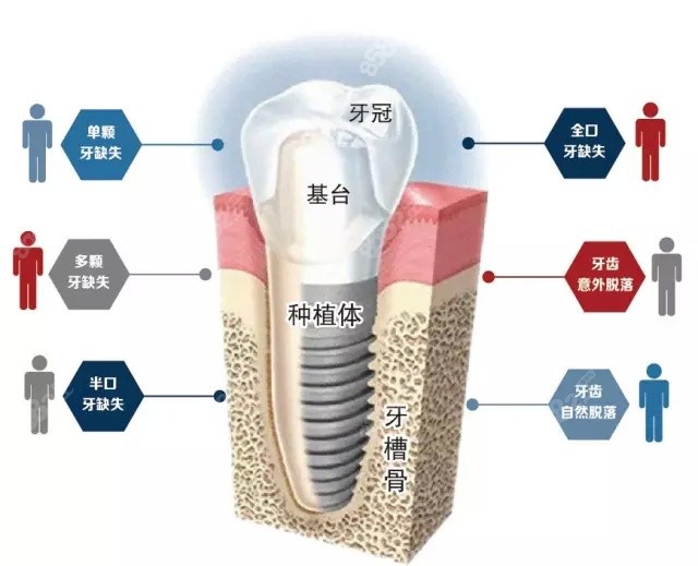 <!--<i data=20240705-sp></i>-->口腔种植牙多少钱一颗