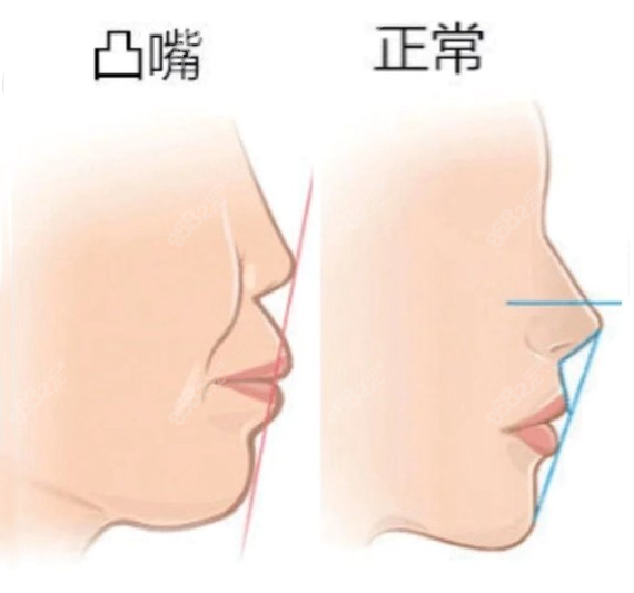 骨性凸嘴不是只能做手术