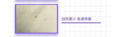 威塑吸脂的傷口很小