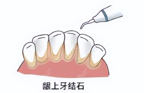 北京牙周炎刮治费用多钱?