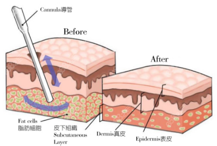 吸脂手術(shù) 吸脂手術(shù)
