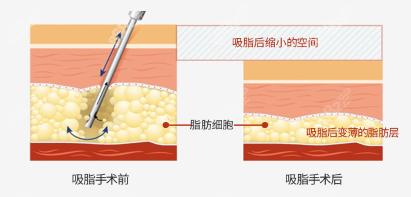 韩国欧佩拉整形做吸脂手术www.8682.cc