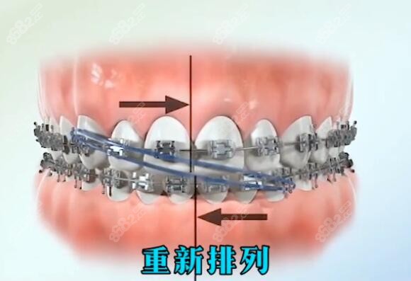 中线不齐脸歪下颌怎么矫正