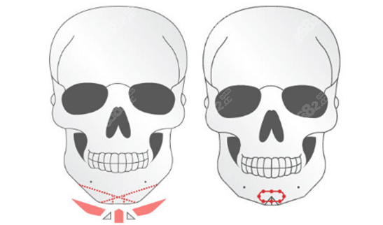羅金超下頜角怎么樣
