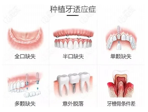 种植4颗牙齿花了6万多元贵吗