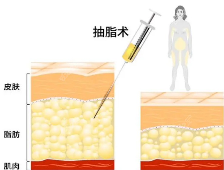 吸脂手術(shù) 吸脂手術(shù)