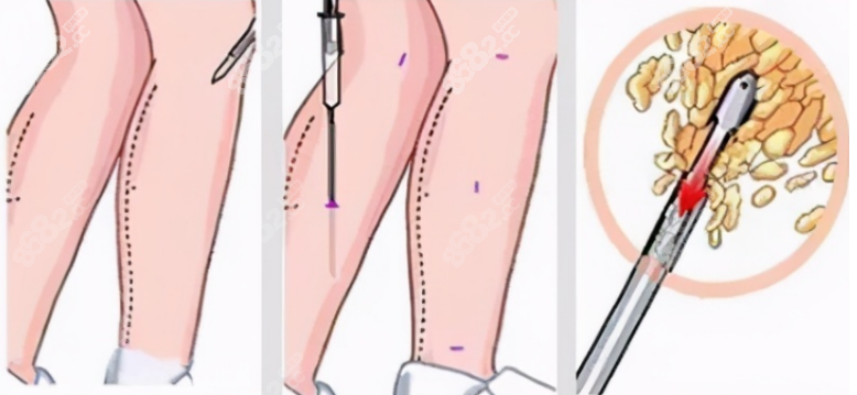 哪家醫(yī)院有土麥森吸脂技術(shù) 哪家醫(yī)院有土麥森吸脂技術(shù)