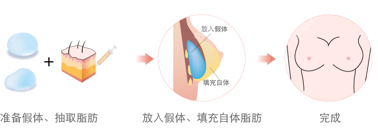 杭州复合隆胸医生哪个好 8682.#cc