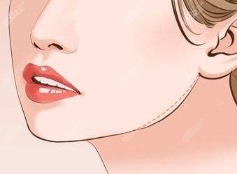 何照華下頜角怎么樣