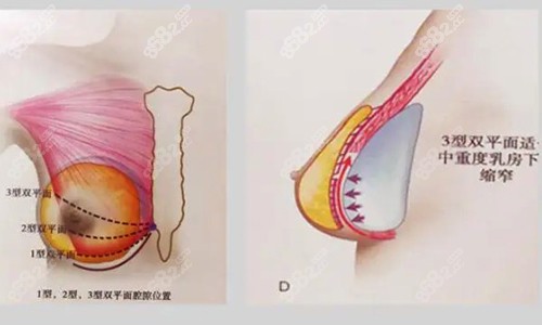 罗盛康隆胸