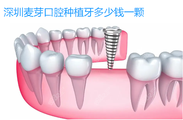 深圳麦芽口腔种植牙价格www.8682.cc