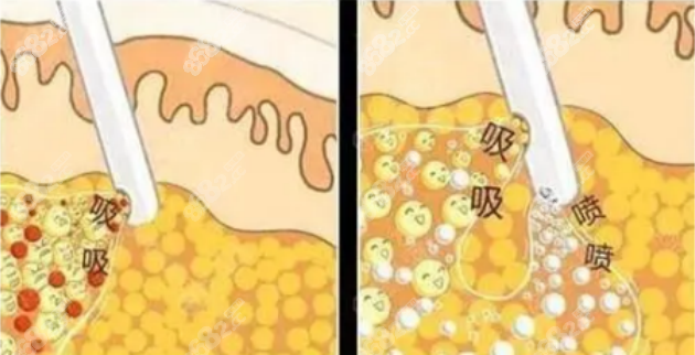 吸脂手術(shù) 吸脂手術(shù)