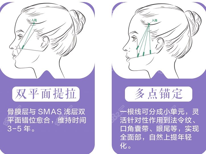 深圳何奇医生做微拉美面部提升好在哪里？