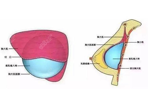 罗盛康隆胸