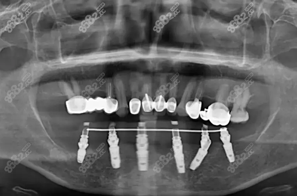晋江全口半固定种植牙价格8682网