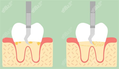 龈下刮治一般需要做2~4次，分次进行