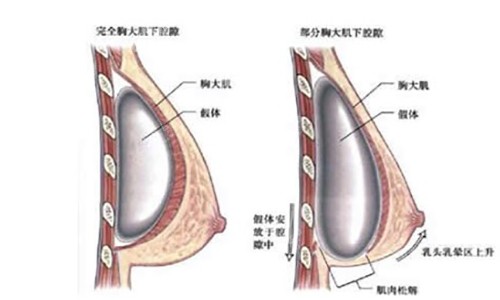 罗盛康隆胸