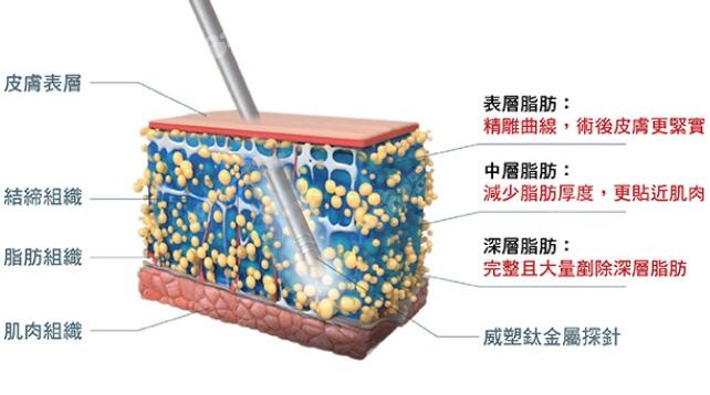 威塑吸脂真的不痛嗎？看下威塑吸脂的原理：