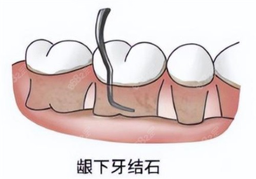 上海牙周炎龈下治疗需要多少钱？