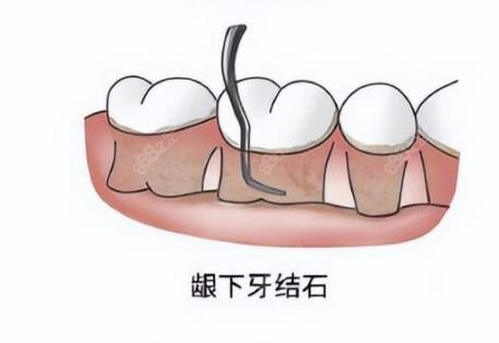 牙龈下刮治的真实感受分享