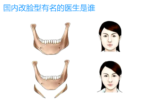 國內(nèi)改臉型有名的醫(yī)生是誰