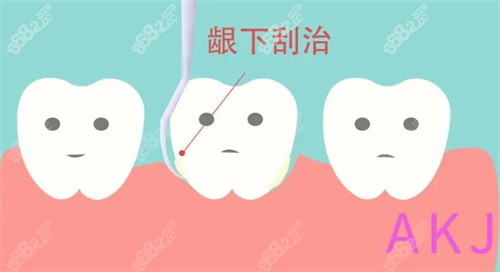 龈下刮治需要治疗几次？