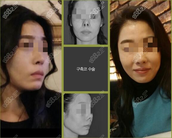 挛缩鼻子修复手术病例