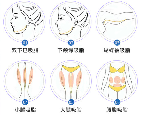 钻石微雕吸脂范围