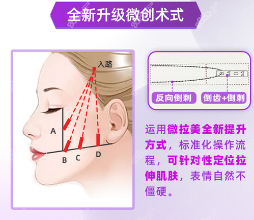 党宁做微拉美提升微创不留疤