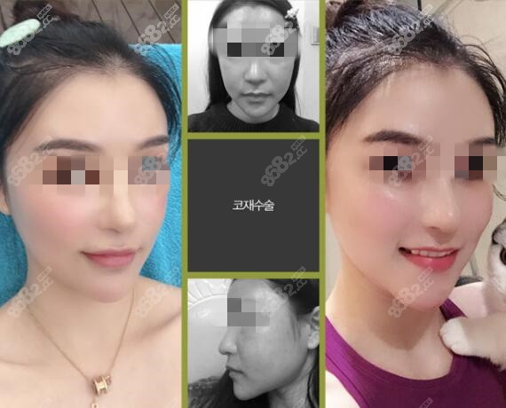 塌鼻子整形病例