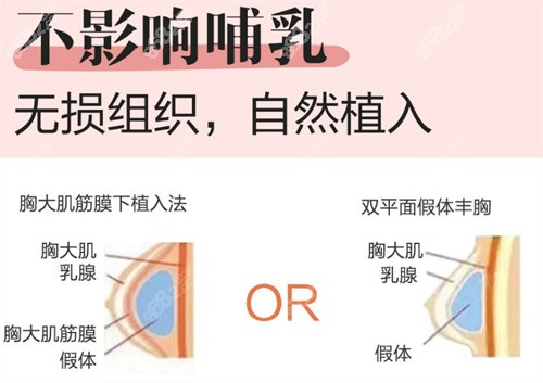 广州曙光刘杰伟做的隆胸手术好吗