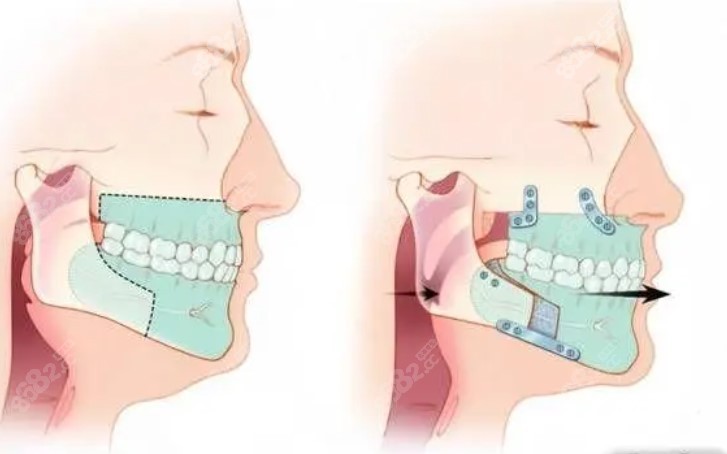 <!--<i data=20240705-sp></i>-->正頜手術(shù)實(shí)例分享8682網(wǎng)分享