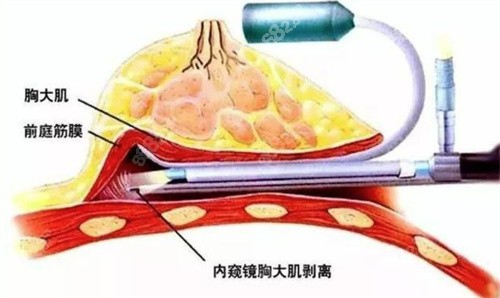 广州曙光刘杰伟做的隆胸手术好吗