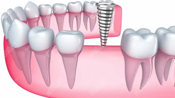 种植牙的八个后遗症