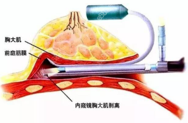 谢卫国医生隆胸手术