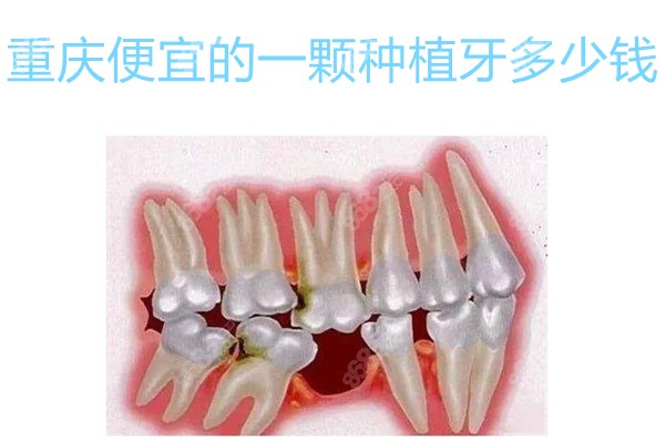 重庆便宜的种植牙多少钱一颗