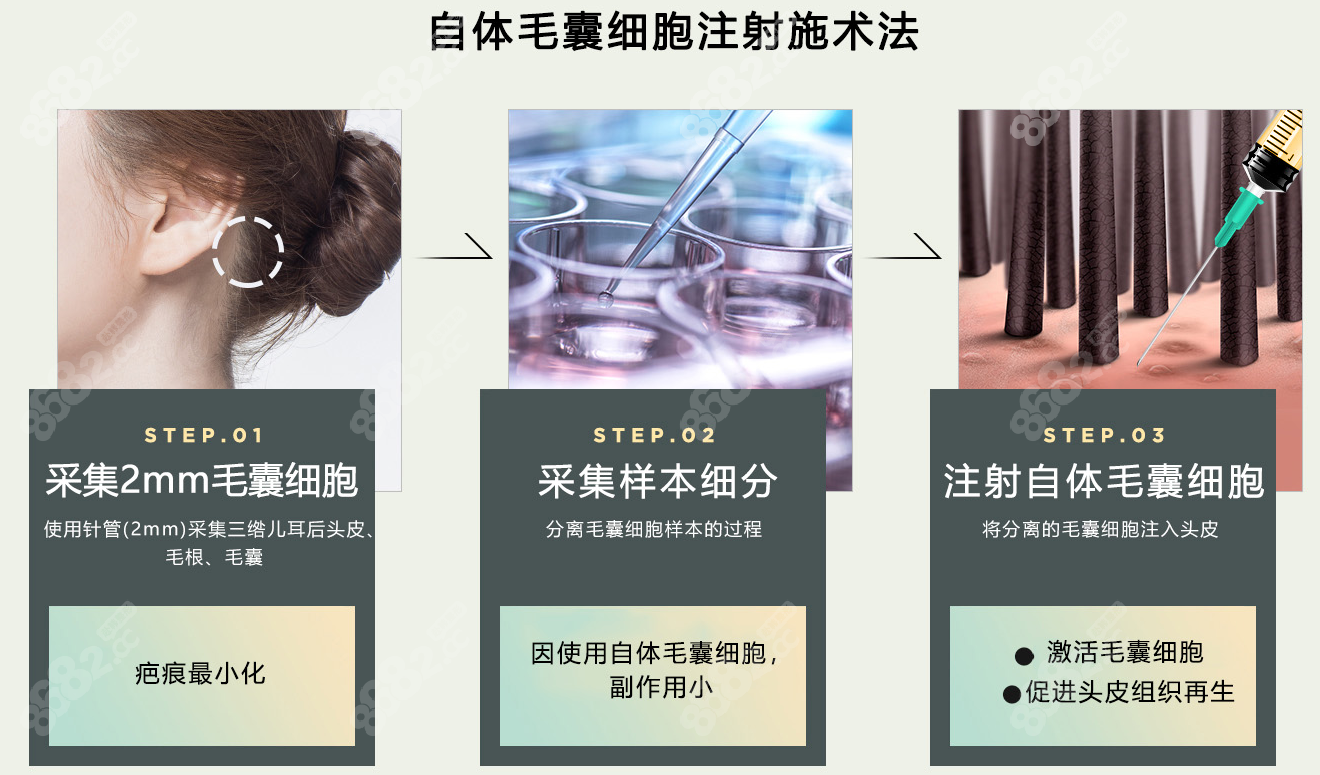 韩国来福琳医院植发之系统细胞疗法介绍