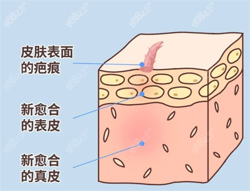 昆大疤痕医院祛疤技术好