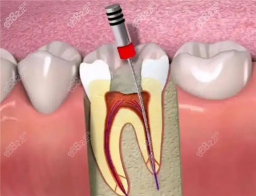牙齿根管治疗动画图