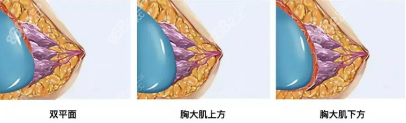 长沙雅美肖征刚隆胸