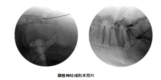 腰椎神经成形术