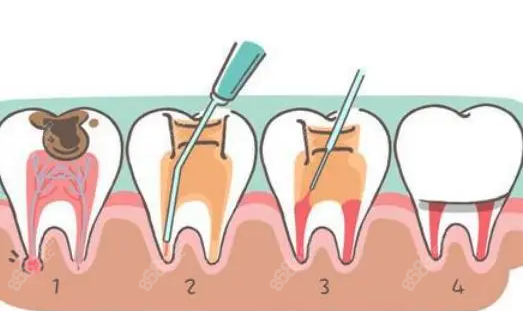 儿童根管治疗大概要什么危害