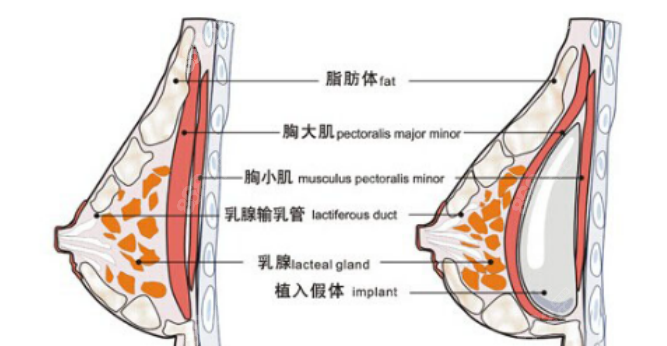 隆胸手术