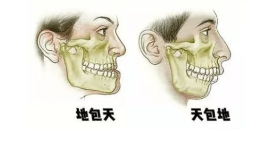30岁骨性地包天和牙性地包天矫正方式不同