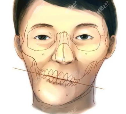 福州骨性偏颌矫正手术费用8682网